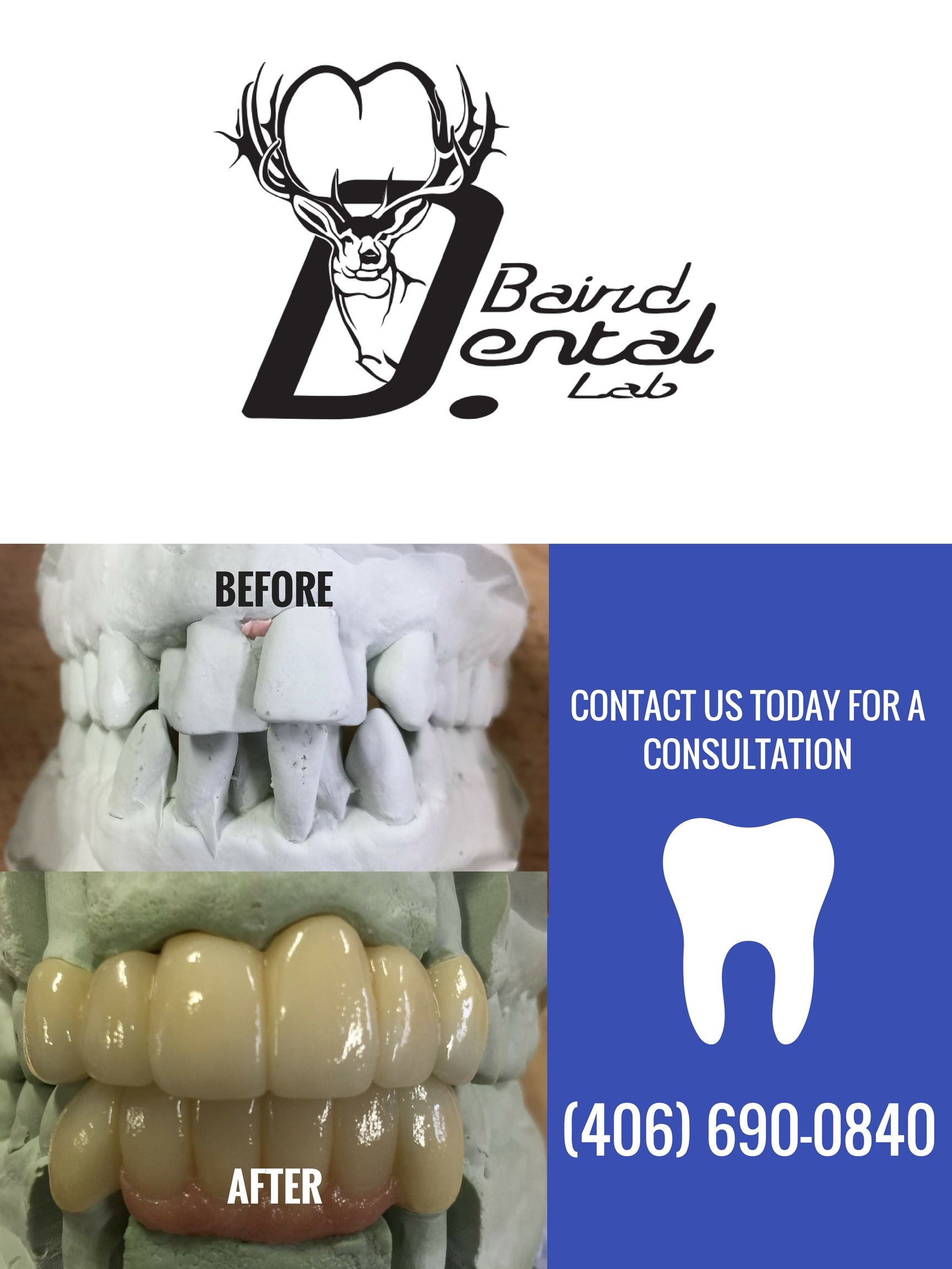 Dental Lab Crowns Dental Bridges Veneers Implants Denture Bruxzir Crowns Zirconia Crowns