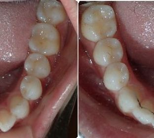 6 months start to finish with Invisalign