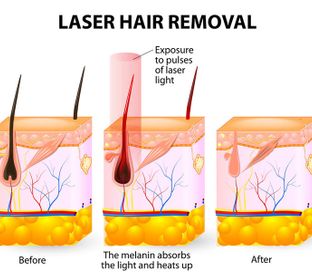 Laser hair removal , hair removal, electrolysis,permanent hair removal